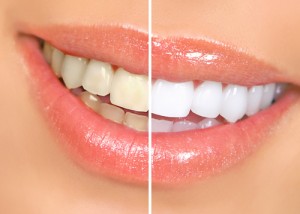 Teeth whitening