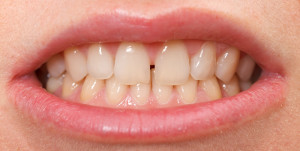 Diastema