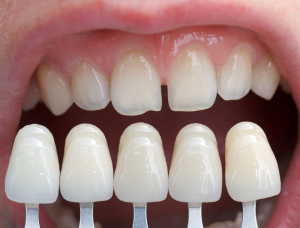 dentalveneers