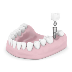 dentalimplantparts