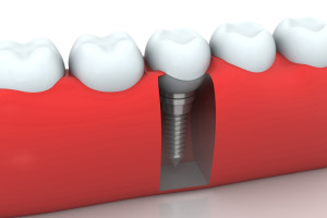 dentalimplantcloseup