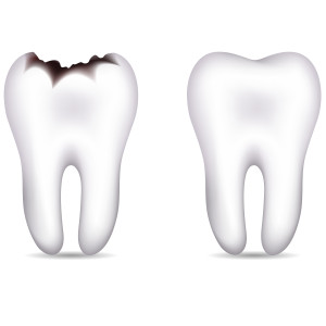 treat your cavity to a tooth-colored filling