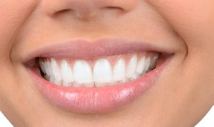 What Is Full-Mouth Rehabilitation?