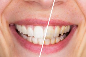 Two Types Of Tooth Stain