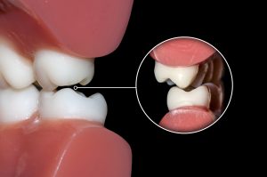 Damage Caused By Grinding Teeth