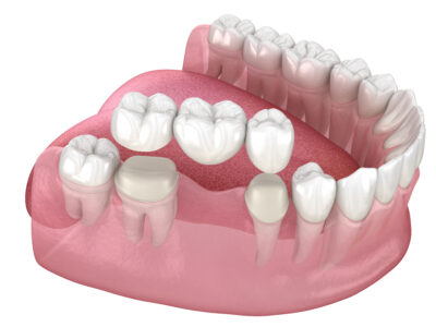 sheridan dental bridges