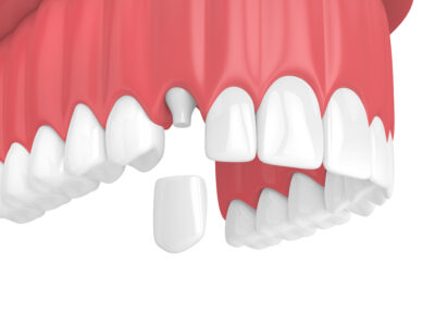 sheridan dental crowns