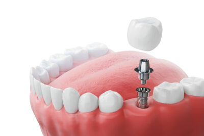 sheridan dental implants