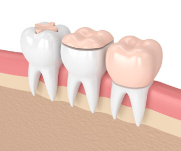 sheridan treating cavities