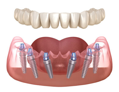 sheridan dental implants