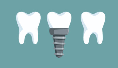 Sheridan, WY, dentist offers dental implants 