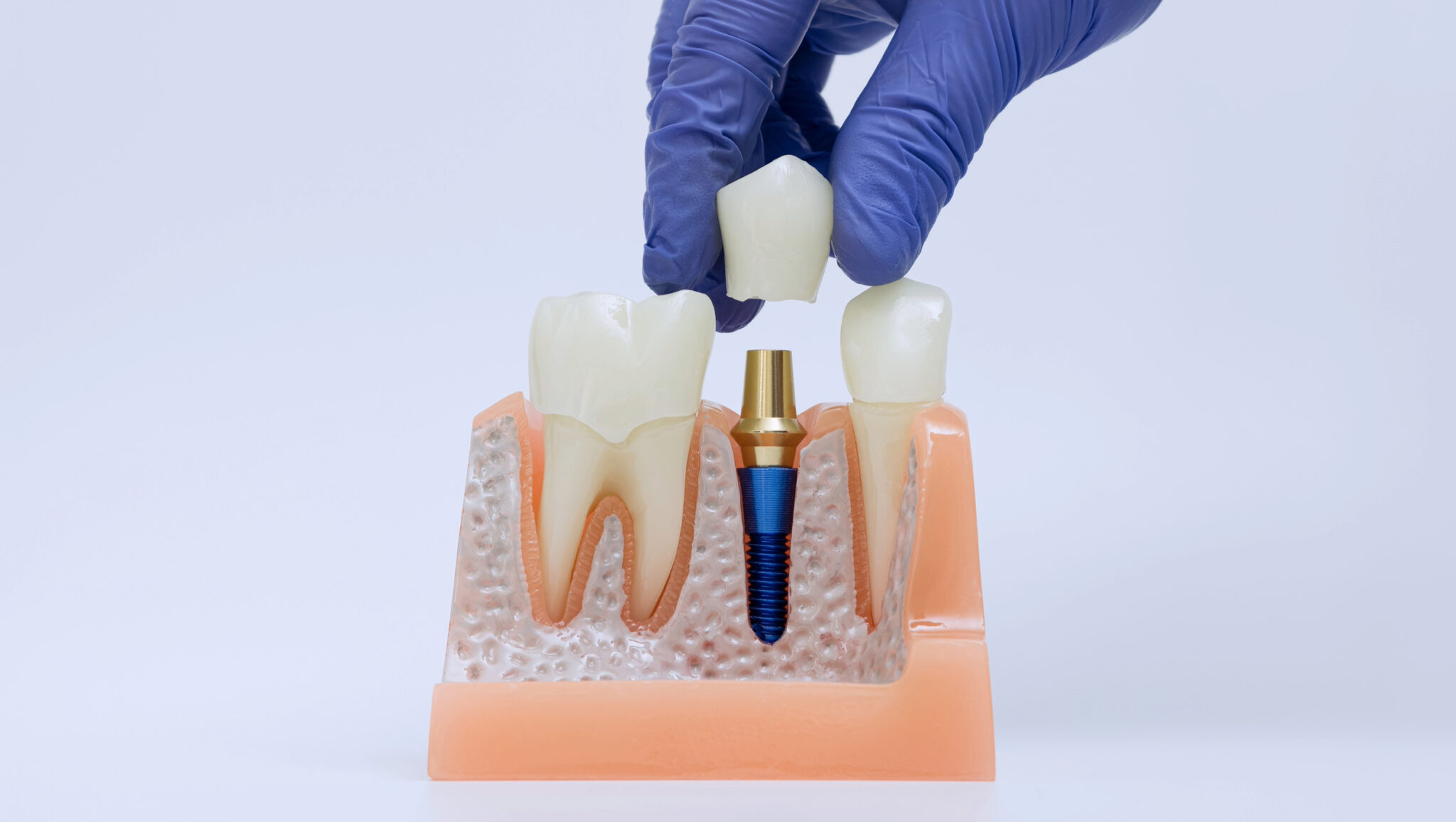 sheridan dental implants