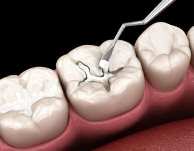 sheridan metal-free fillings