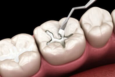 sheridan metal-free fillings