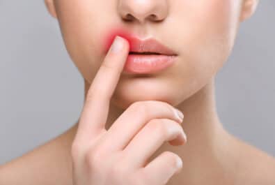 sheridan cold sore laser treatment