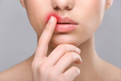 sheridan cold sore laser treatment