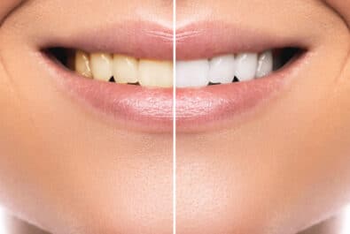 sheridan teeth whitening