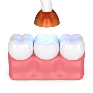 sheridan dental filling